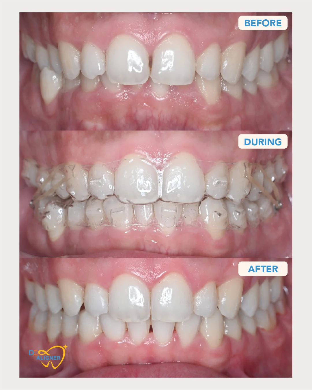 เคสจัดฟันใส DC Aligner ก่อน ระหว่าง และหลังรักษา