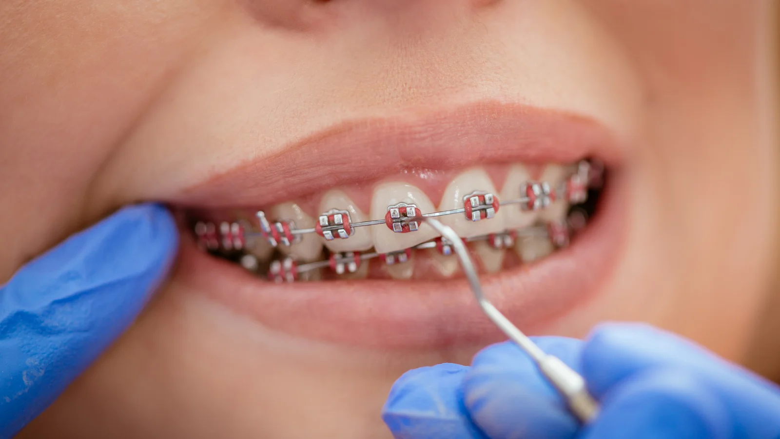จัดฟันโลหะ Metal Braces