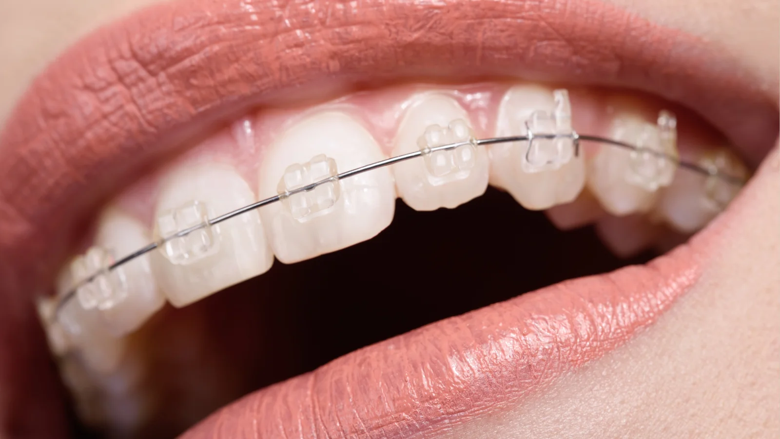 จัดฟันโลหะ Metal Braces