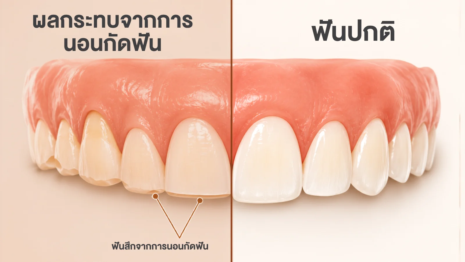 ฟันสึกจากการนอนกัดฟัน เปรียบเทียบกับฟันปกติ