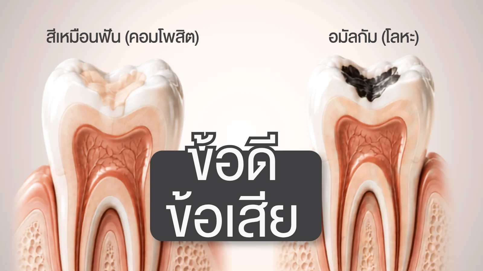 ขั้นตอนการอุดฟัน 5 ขั้นตอน