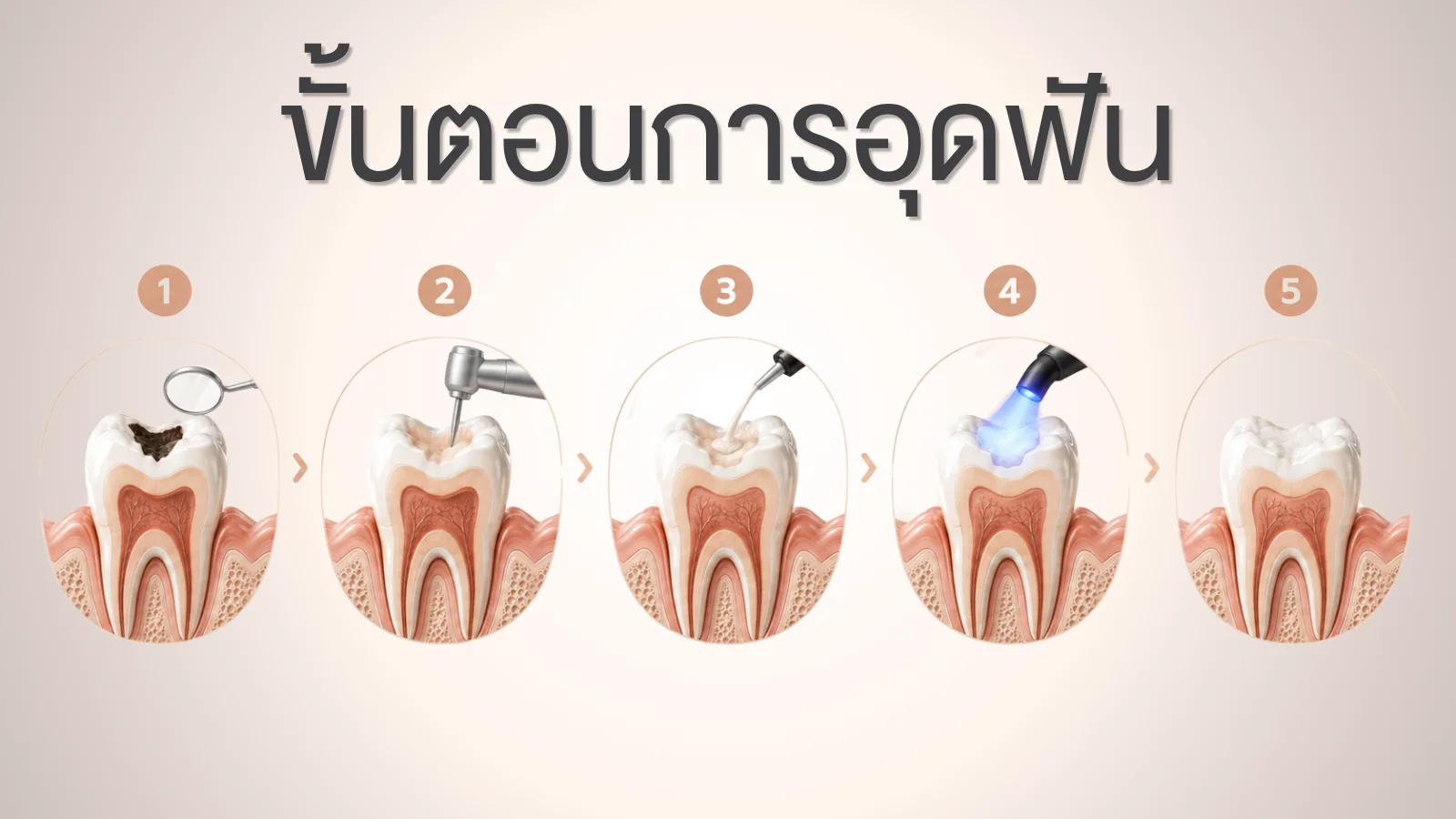 เปรียบเทียบวัสดุอุดฟัน คอมโพสิตสีเหมือนฟัน กับอมัลกัมโลหะ ข้อดีข้อเสีย