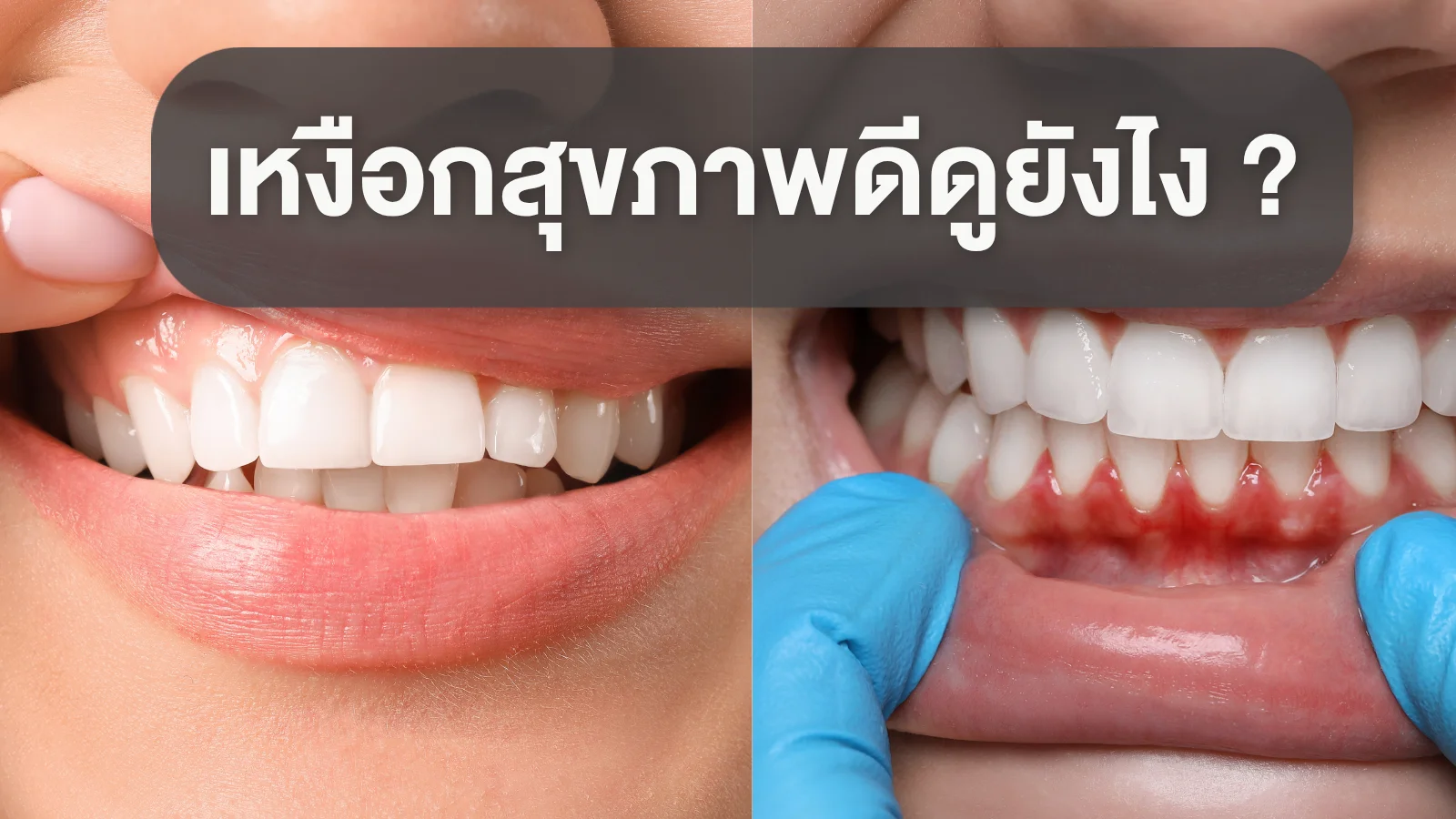 เลือดออกตามไรฟัน บ่งบอกโรคอะไรได้บ้าง