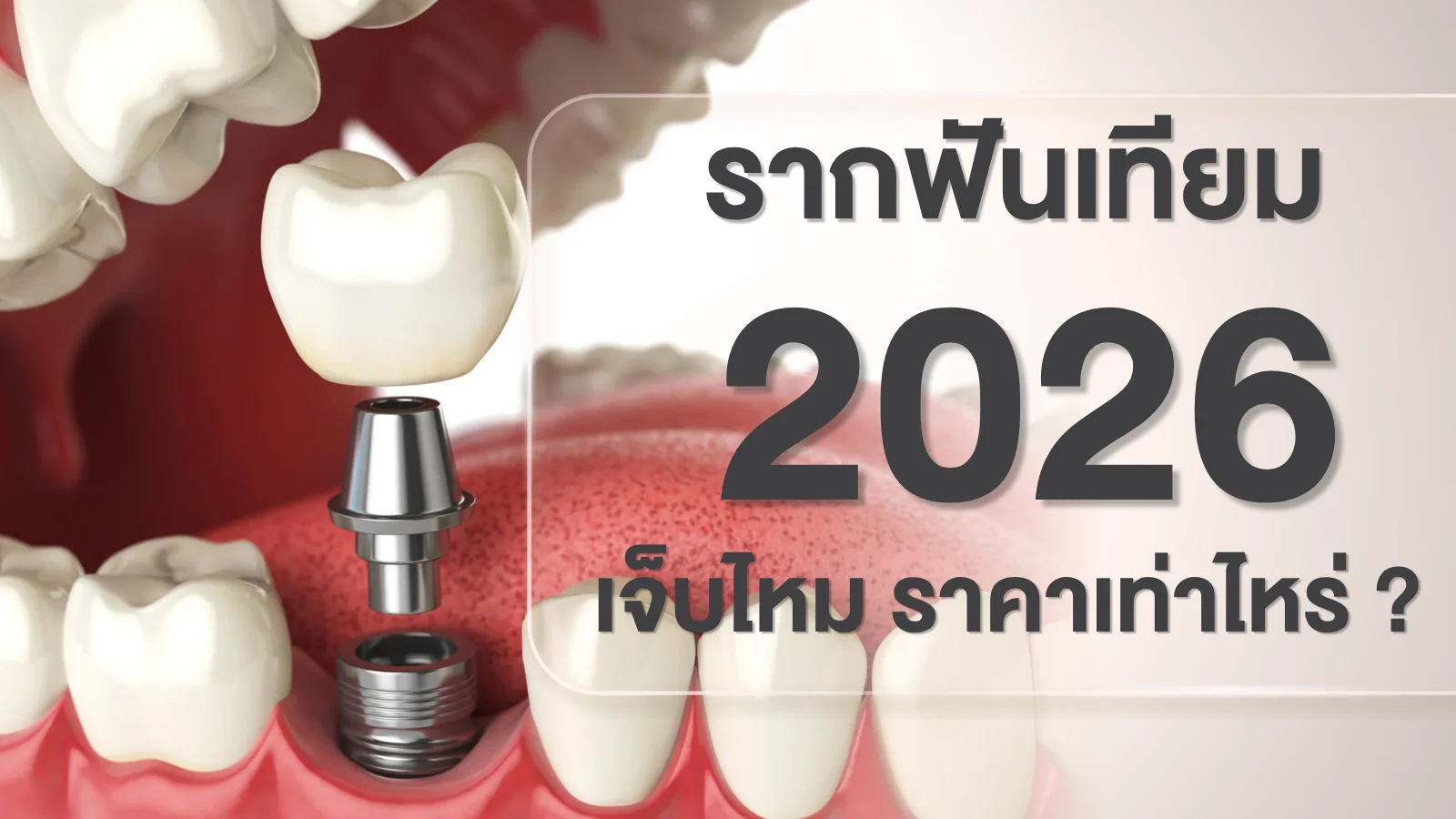รากฟันเทียม 2026 เจ็บไหม ราคาเท่าไหร่ โครงสร้างรากเทียม เดือย ครอบฟัน