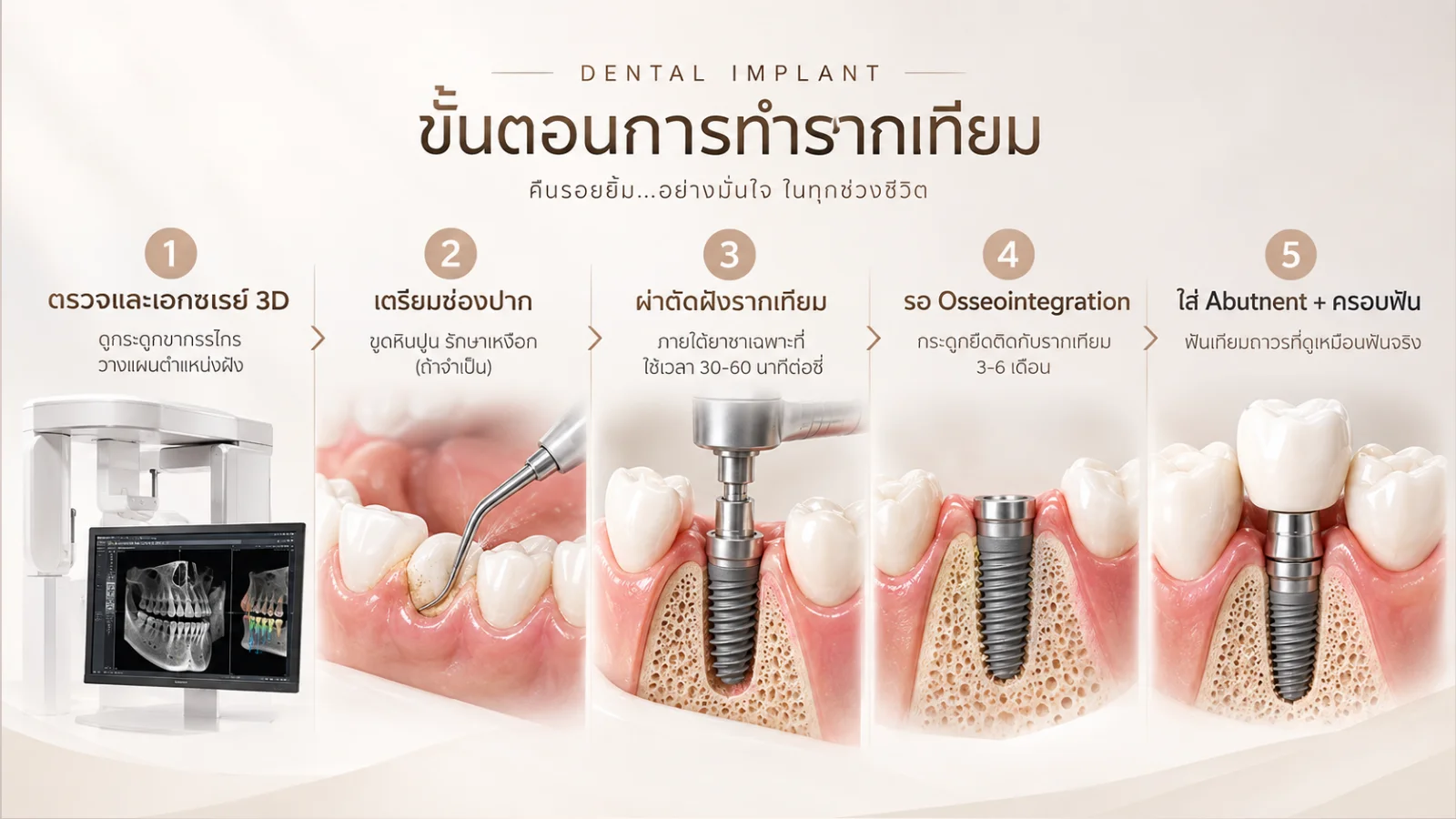 ฟันปลอมยึดบนรากฟันเทียม Implant-Supported Denture