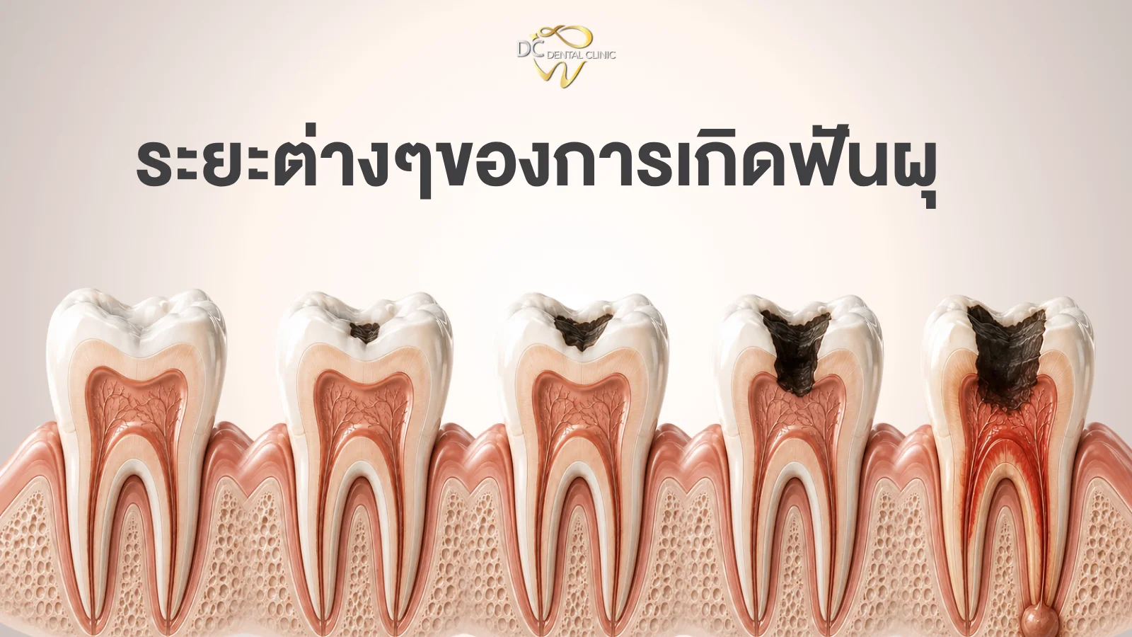 ระยะต่างๆ ของการเกิดฟันผุ ตั้งแต่ผุตื้นถึงทะลุโพรงประสาทฟัน