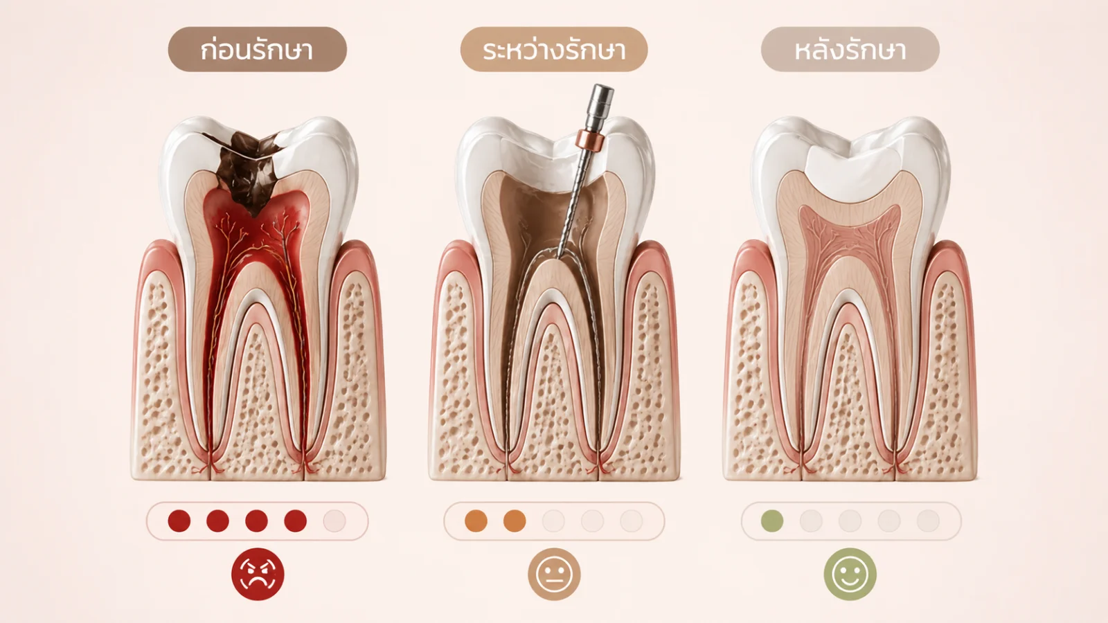 เปรียบเทียบระดับความเจ็บ ก่อนรักษา ระหว่างรักษา และหลังรักษารากฟัน