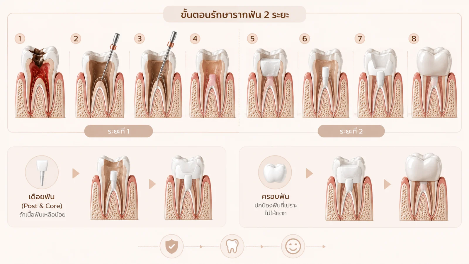 อินโฟกราฟิกขั้นตอนรักษารากฟัน 2 ระยะ พร้อมเดือยฟันและครอบฟัน