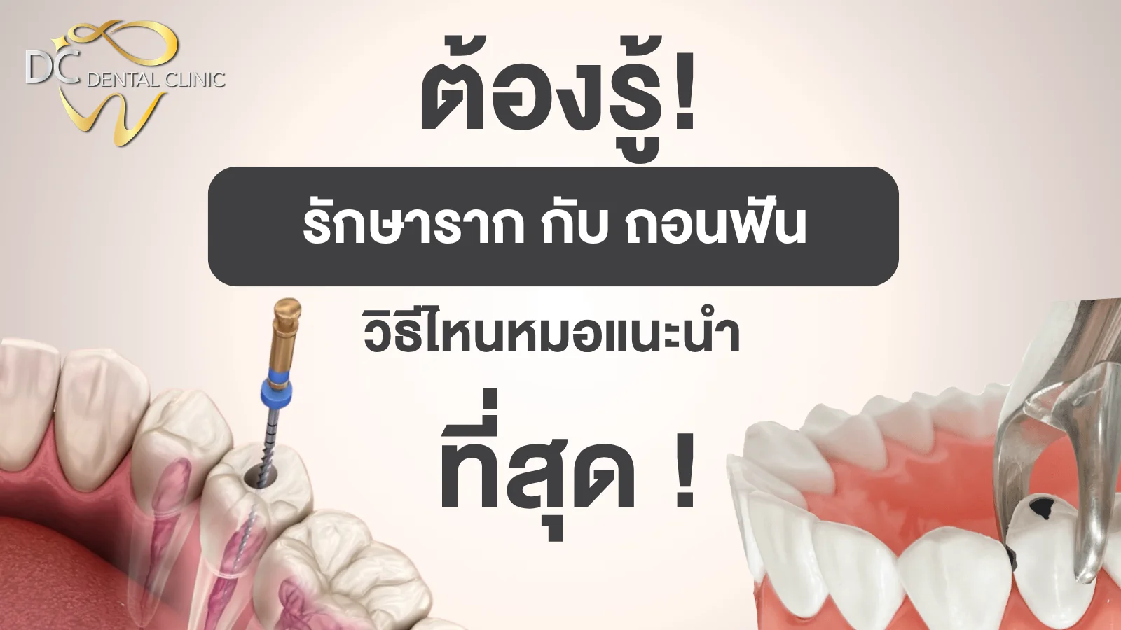 เปรียบเทียบการรักษารากฟันกับการถอนฟัน วิธีไหนดีกว่า