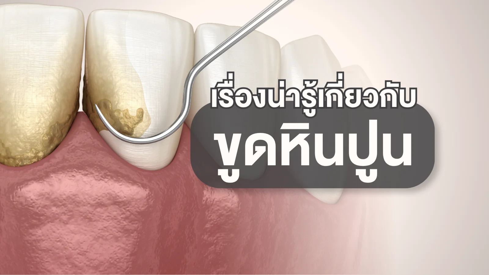 ขูดหินปูน — คราบหินปูนเกาะที่คอฟันและเครื่องมือขูดหินปูน