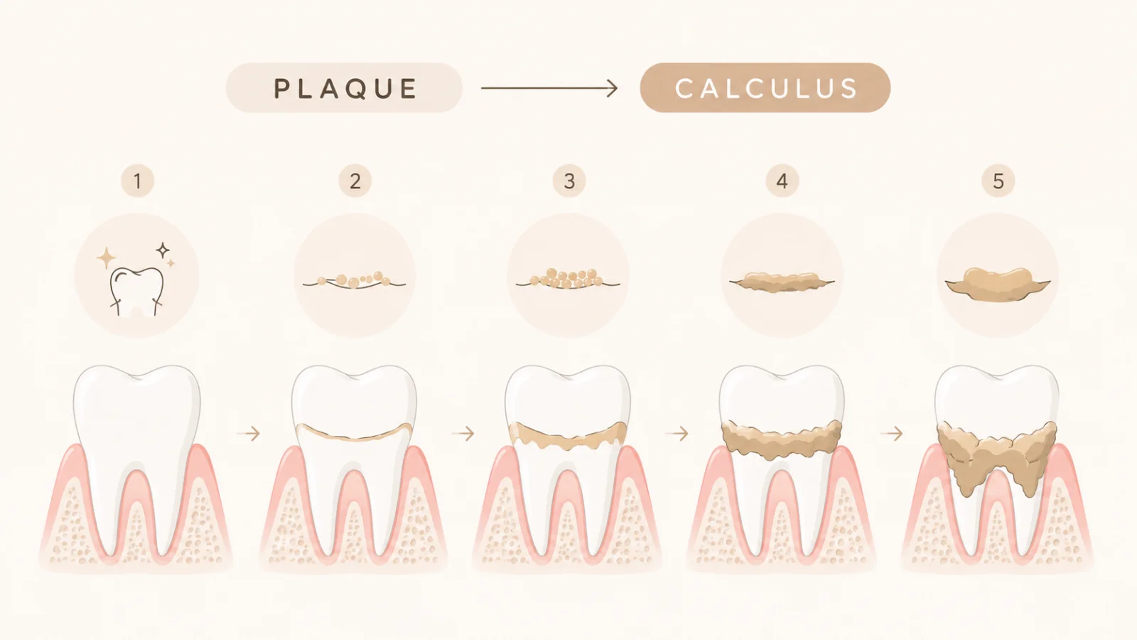 อินโฟกราฟิกกระบวนการเกิดหินปูน จากคราบจุลินทรีย์ Plaque กลายเป็นหินปูน Calculus