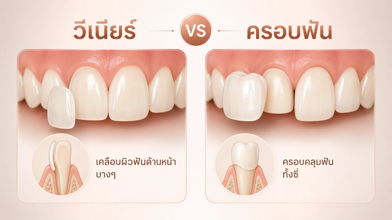 เปรียบเทียบวีเนียร์กับครอบฟัน