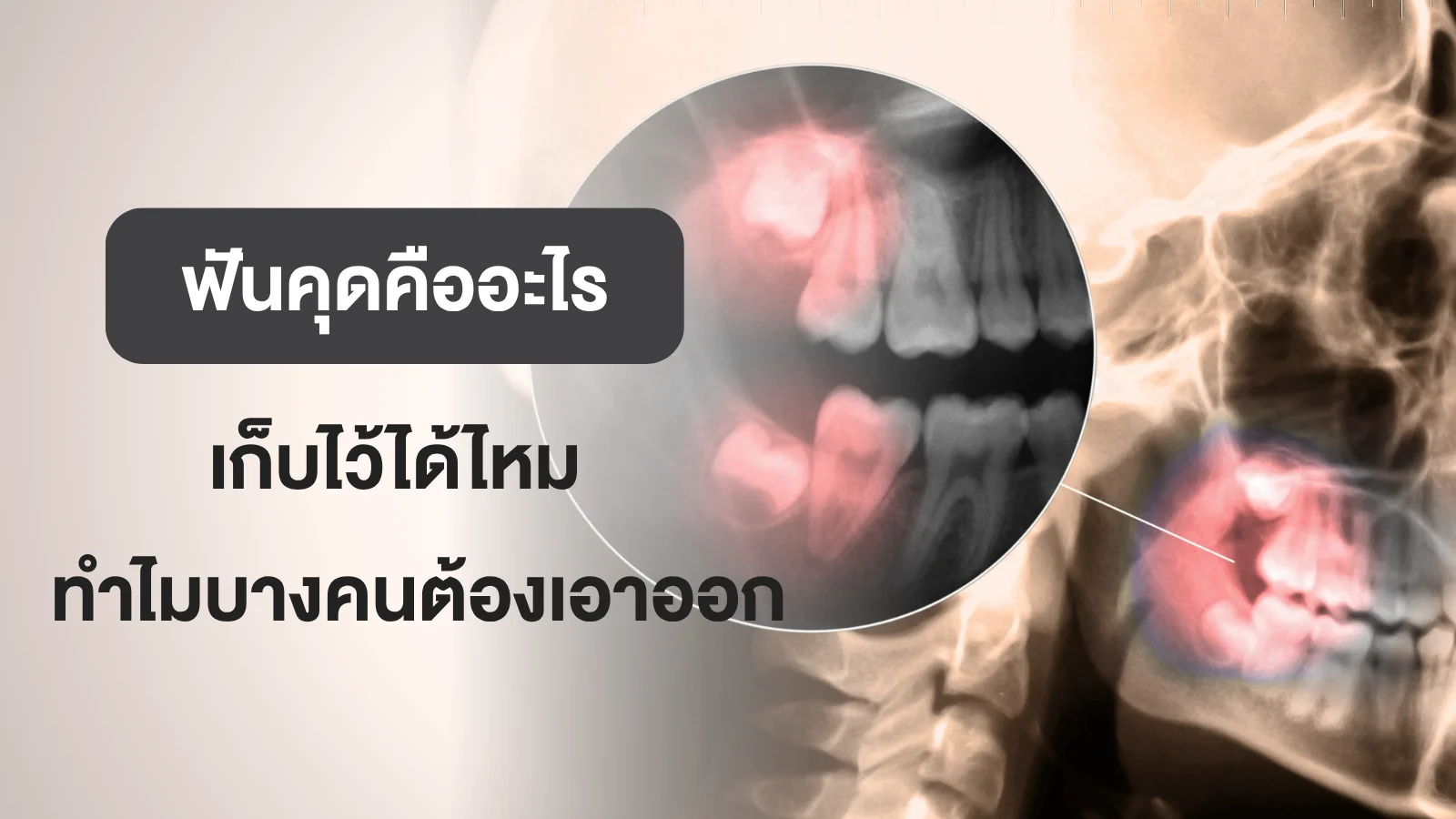 เอกซเรย์ฟันคุด ฟันคุดคืออะไร เก็บไว้ได้ไหม