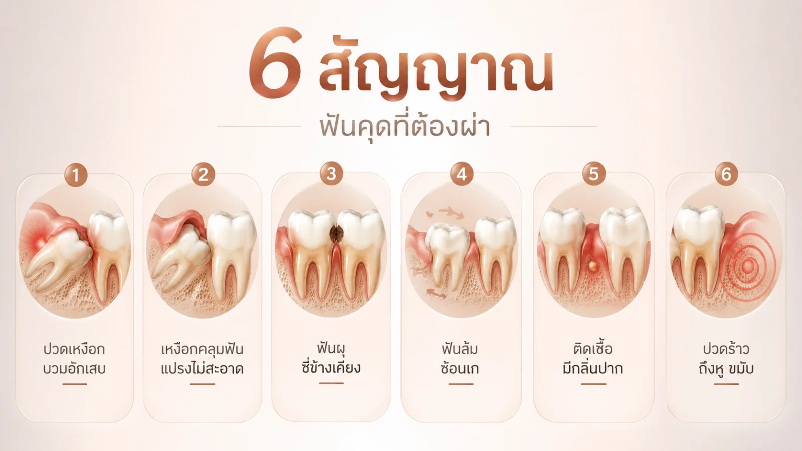 6 สัญญาณฟันคุดที่ต้องผ่า