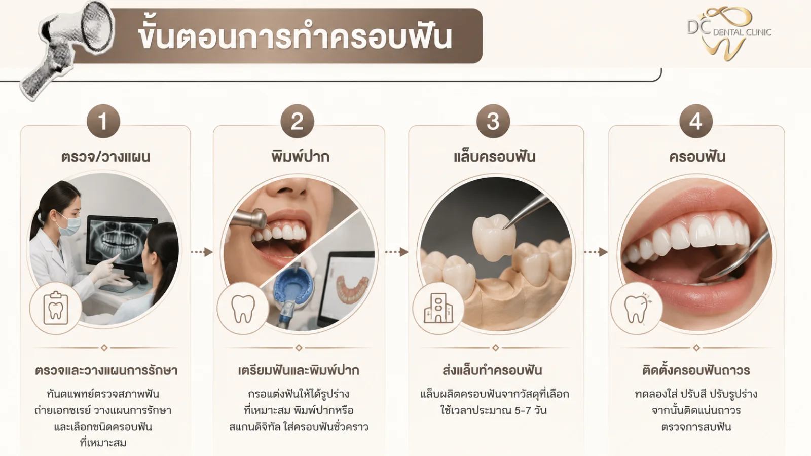 ขั้นตอนการทำครอบฟัน 4 ขั้นตอน — ตรวจ/วางแผน พิมพ์ปาก แล็บครอบฟัน ติดตั้งครอบฟันถาวร
