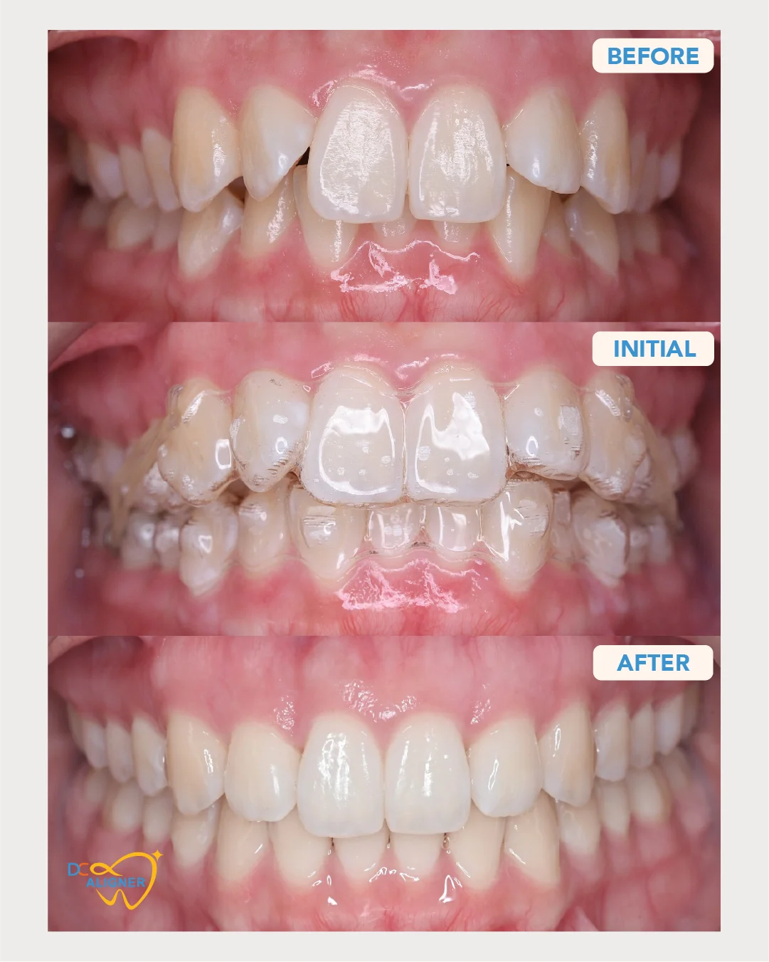 เคสจัดฟันใส Invisalign ก่อน-หลังรักษา