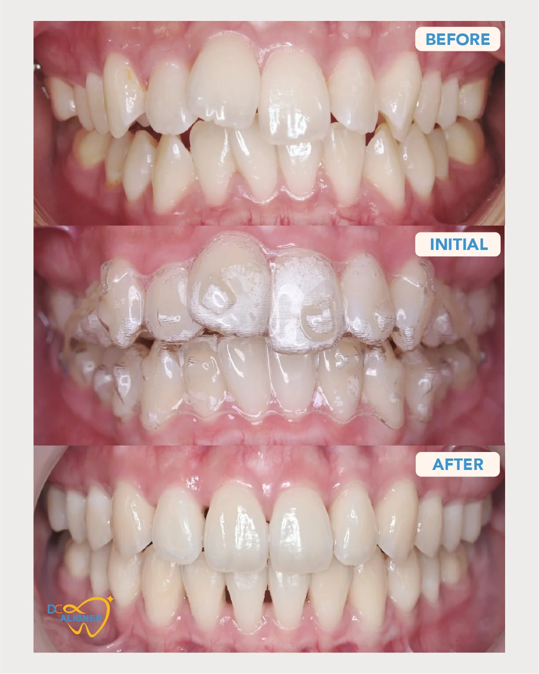 เคสจัดฟันใส Invisalign ก่อนและหลังรักษา