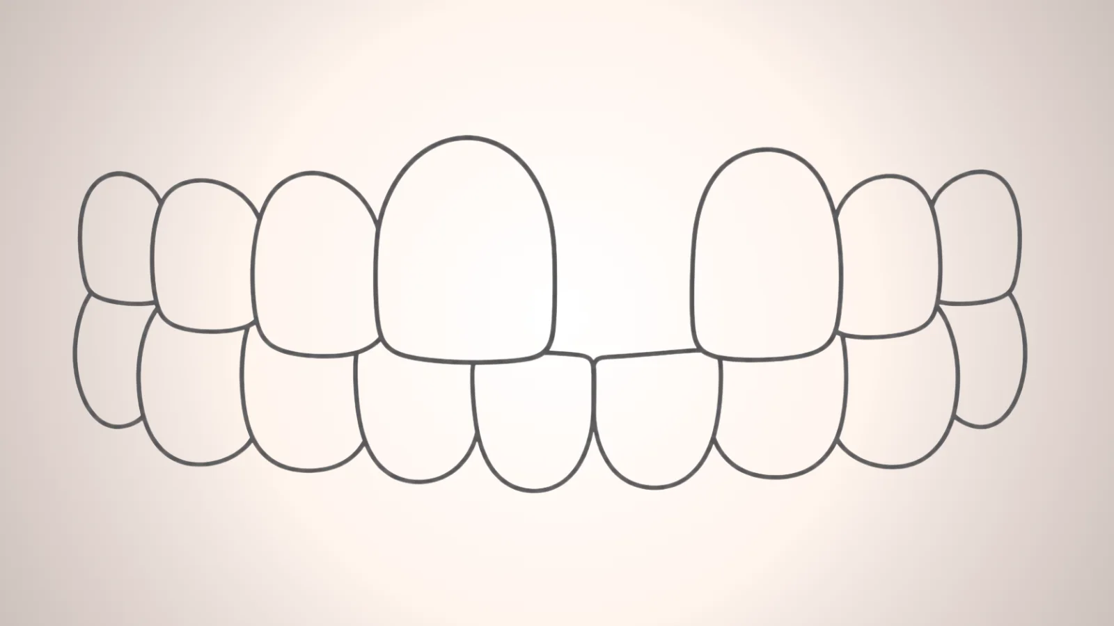 ภาพกราฟฟันหายไปหนึ่งซี่