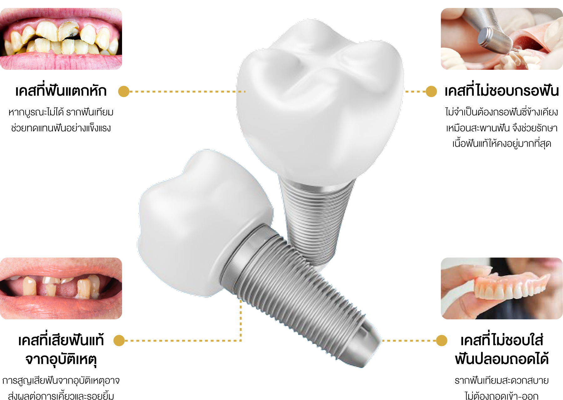 รากฟันเทียม จันทบุรี