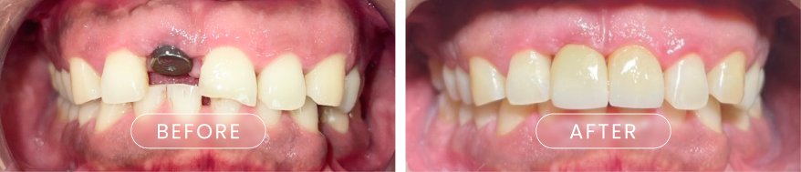 รากฟันเทียม จันทบุรี